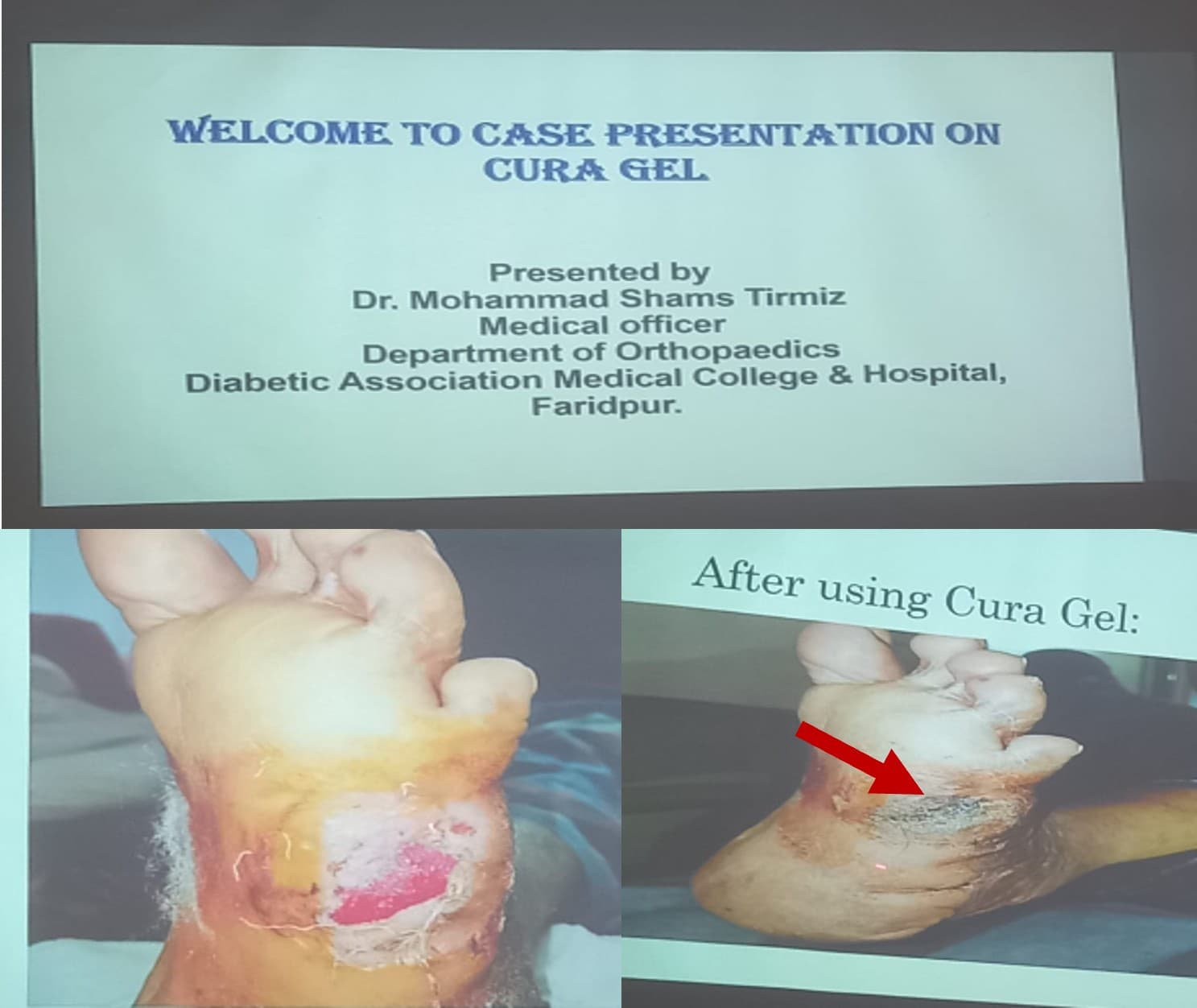 BioEnclave Products Now Available at Faridpur Diabetic Association Hospital
